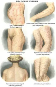 як лікувати алергічні висипання