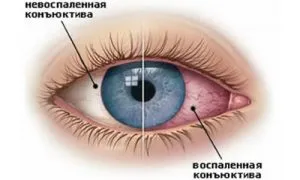 лікувати очної хламідіоз