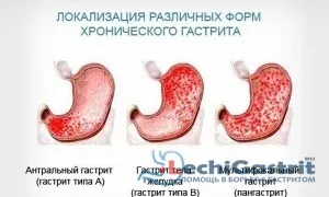 як лікувати гастрит у дорослих