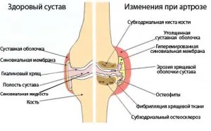 Артроз колінного суглоба 3 ступеня: лікування, лакарства чи можна вилікувати артроз 3 ступеня