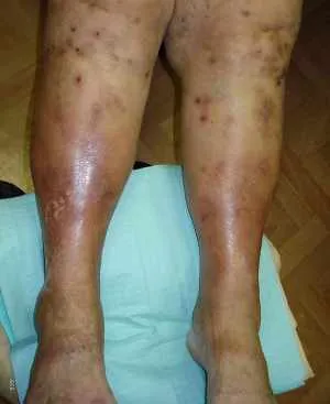 Застійний дерматит на ногах як лікувати застійний дерматит