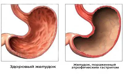 Атрофічний гастрит шлунка вилікувати атрофічний гастрит