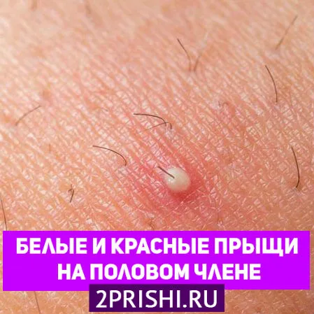 Білі прищики на члені: причини як лікувати прищі на члені