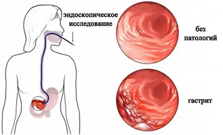 як лікувати алкогольний гастрит