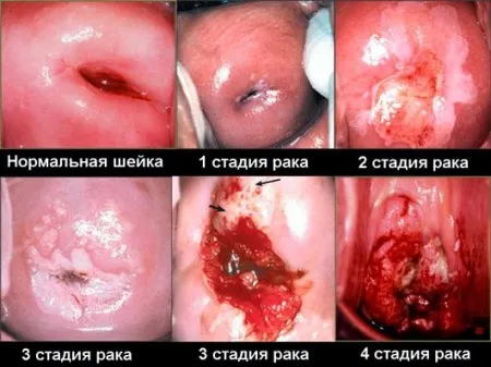 4 Стадія раку шийки матки рак шийка матка 4 стадія ступінь жінка симптом ознака діагностика лікування прогноз відео
