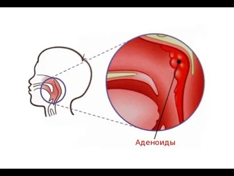 як вилікувати аденоїди 2 ступеня