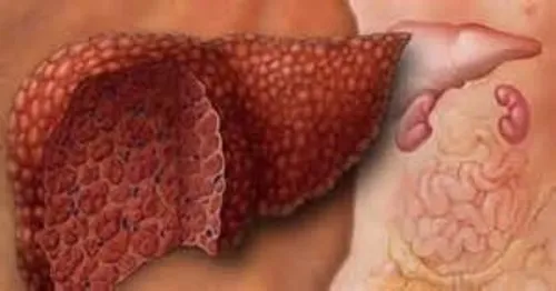 як лікувати цироз печінки і асцит