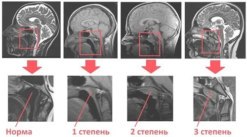 як вилікувати аденоїди 2 ступеня