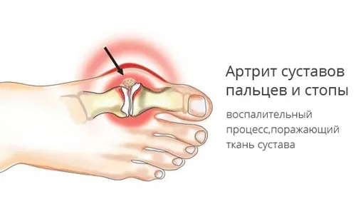 як лікувати артрит суглобів стопи