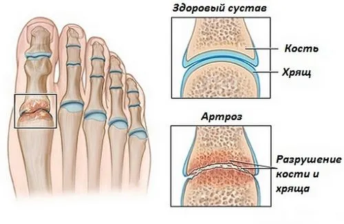 як лікувати суглоб голеностопа