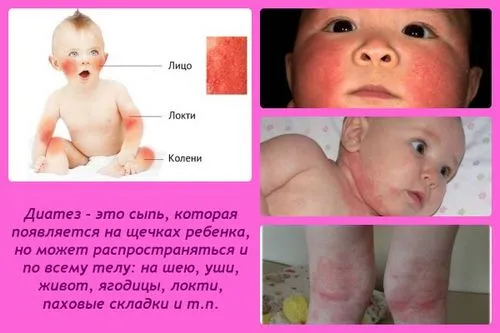 Алергічний діатез у дітей: причини, симптоми, лікування, профілактика, фото, відео як лікувати алергічний діатез