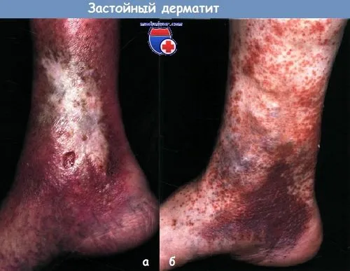 Застійний дерматит - причини, лікування як лікувати застійний дерматит