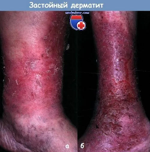 Застійний дерматит - причини, лікування застійний дерматит