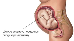Цитомегаловірус у дітей: симптоми, причини, лікування як лікувати цитомегаловірус у дитини