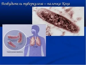 чи можна вилікувати дисемінований туберкульоз