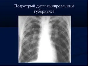 дисемінований туберкульоз легенів заразний заразитися