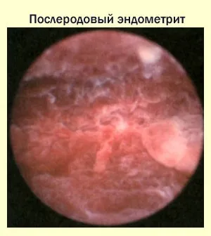 як лікувати хворобу ендометрит
