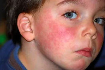 Діатез: види, симптоми, лікування ознака