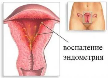 Ендометрит - симптоми і лікування як лікувати гострий ендометрит