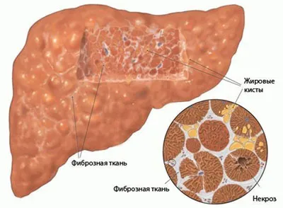як лікувати фіброз печінки народними засобами