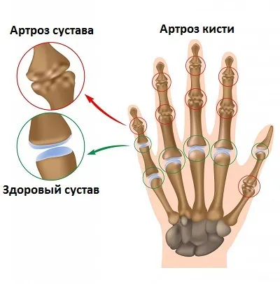 як лікувати суглоби кистей рук