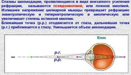 чи можна вилікувати короткозорість у дитини 3 років