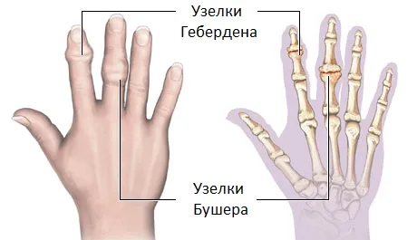 як лікувати суглоби кистей рук