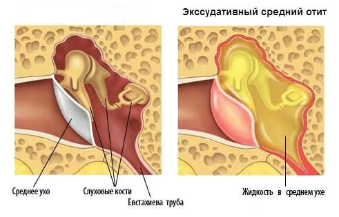 як правильно лікувати ексудативний отит