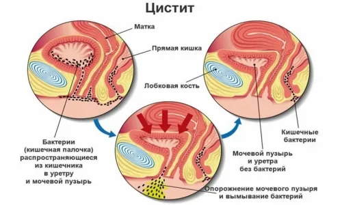 як лікувати сечовий міхур під час вагітності