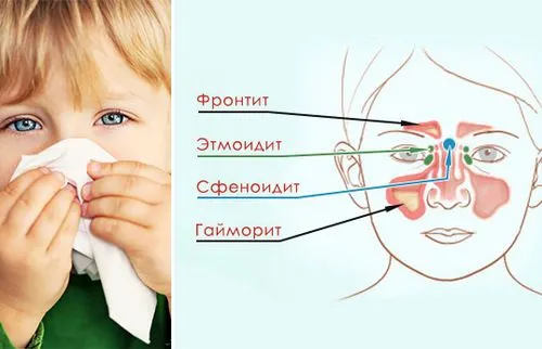 фронтит у дітей