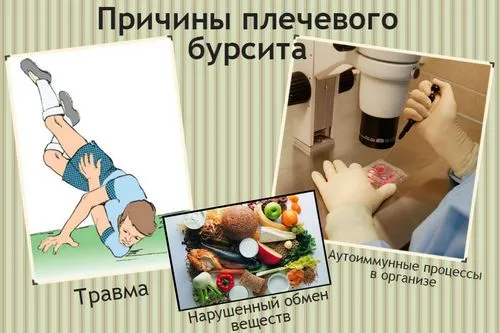 як лікувати бурсит плеча