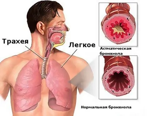 як лікувати алергічну астму народними засобами