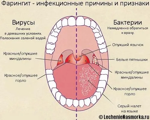 як лікувати хворобу фарингіт