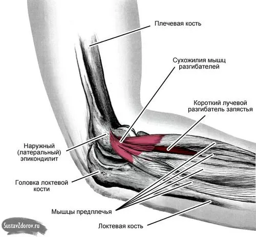 як лікувати епікондиліт ліктьового суглоба
