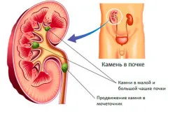 як лікувати кальцинат нирки