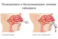 Як вилікувати гайморит назавжди як вилікувати синусит назавжди