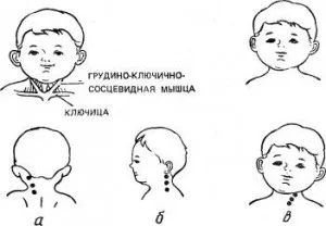 як лікувати викривлення шиї