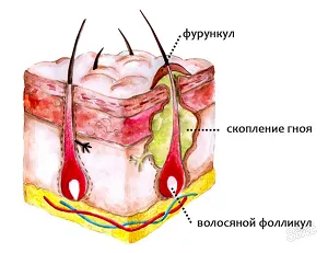 фурункул причини