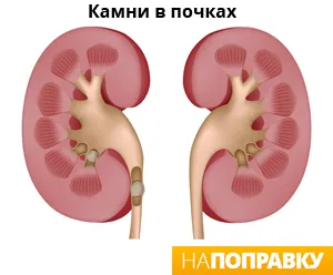 огляд каменів в нирках (нефролітіазу)