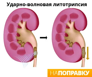 камені в нирках (нефролітіаз)