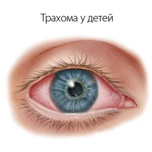 Як лікувати хламідіоз очей як лікувати хламідіоз очей