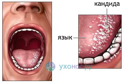 як лікувати кандидоз горла у дітей
