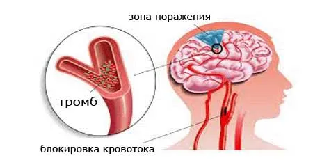 як лікувати наслідки ішемічного інсульту