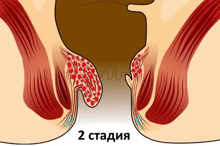 як лікувати хронічний геморой 2 ступеня