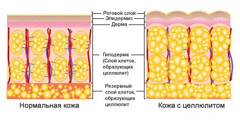 як лікувати целюліт 3 стадії