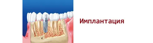 - Icon- інноваційне лікування карієсу без препарування!