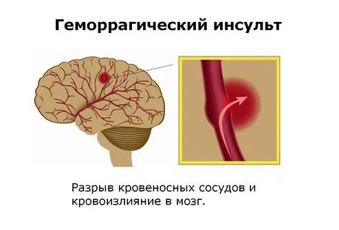 як лікувати правобічний інсульт