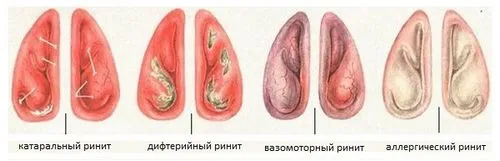 Інгаляції при риніті як лікувати нежить небулайзером