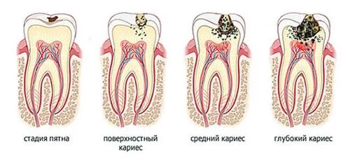 вилікувати карієс