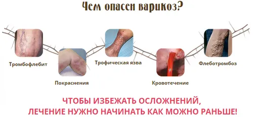 як лікувати варикоз ніг